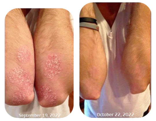 Adiós a la Picazón y la Irritación en Días - Spray Alivio Psoriasis KOLMAX