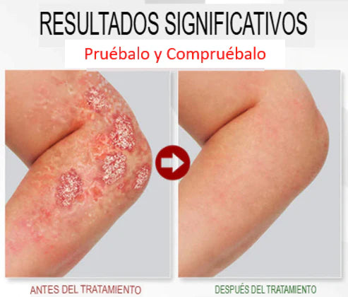 Adiós a la Picazón y la Irritación en Días - Spray Alivio Psoriasis KOLMAX
