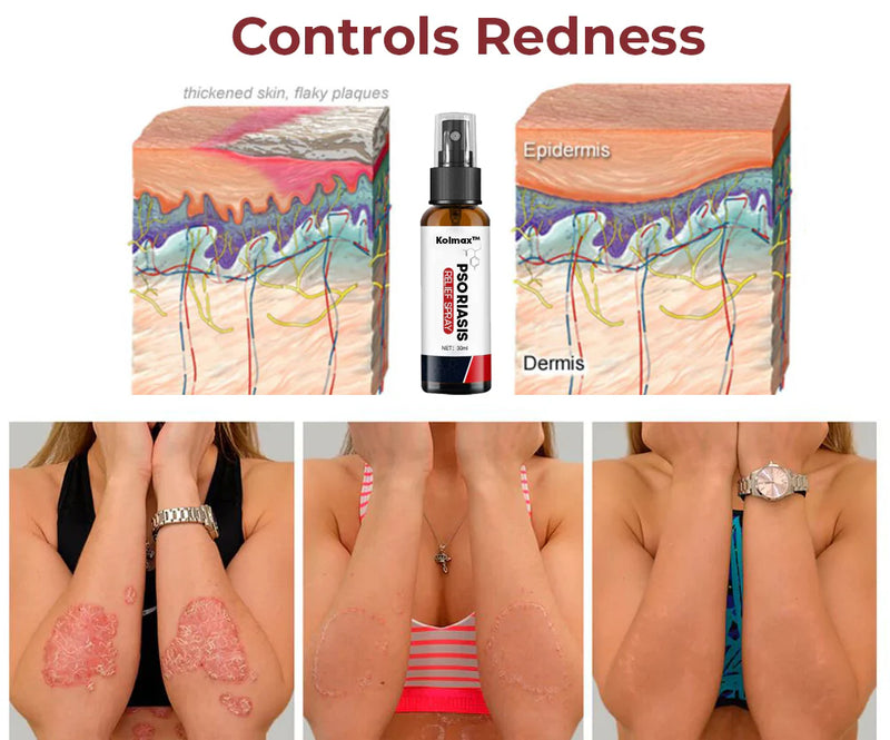 Adiós a la Picazón y la Irritación en Días - Spray Alivio Psoriasis KOLMAX